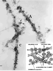 Mikroskopische Aufnahme und schematische Darstellung von Hyaluron-Kollagenfasern im Glaskörper.
