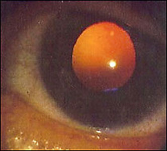 Der objektive Eindruck von Glask�rpertr�bungen aus der Sicht des Augenarztes.